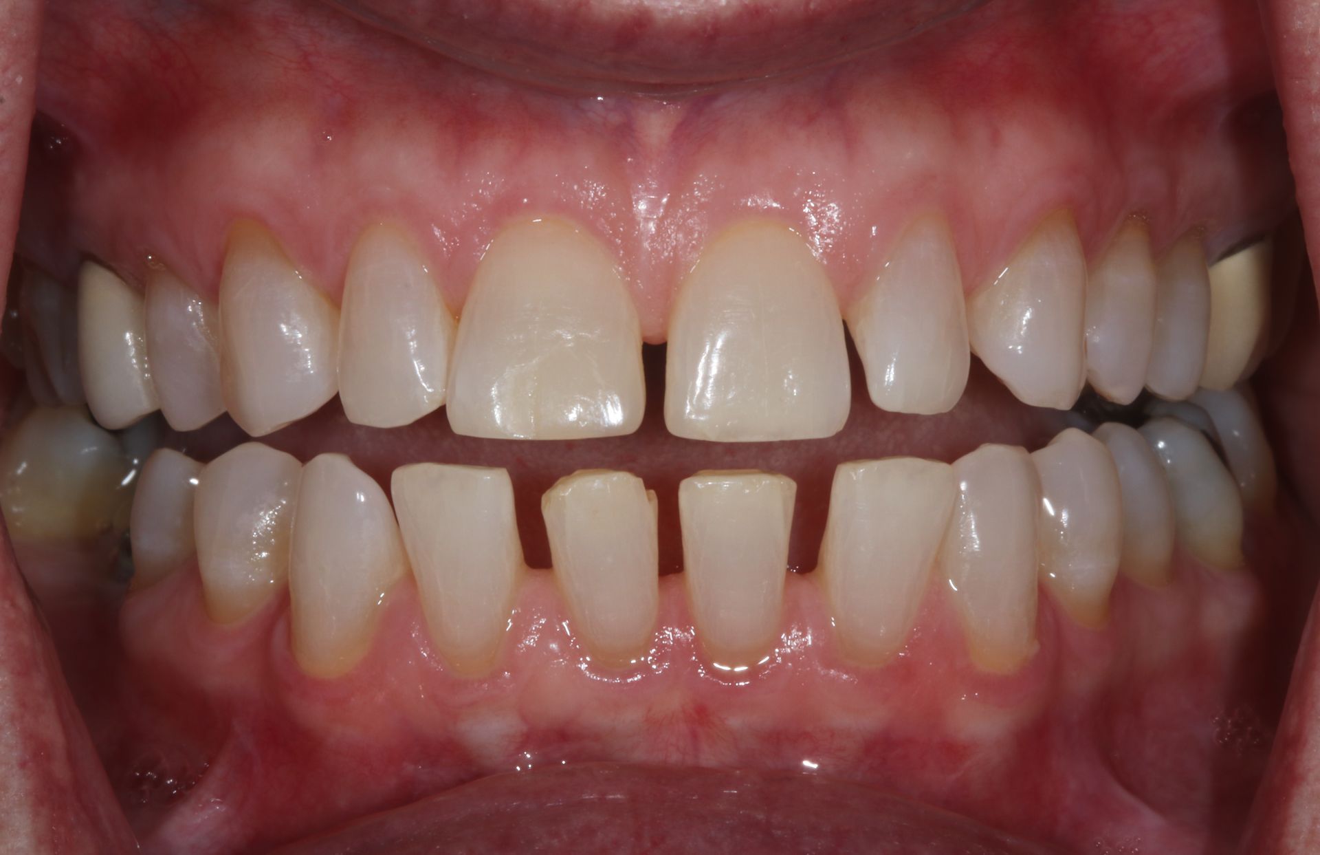 BEFORE Invisalign treatment new holland pa patient 2