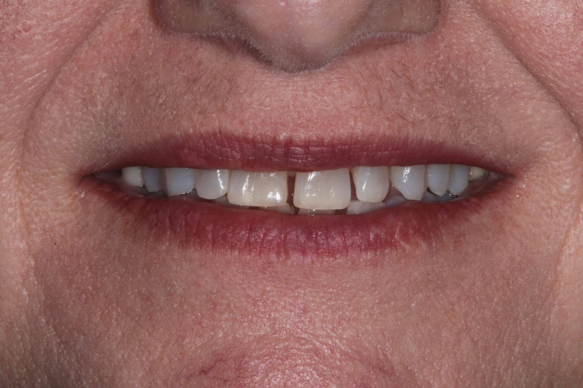 BEFORE Invisalign treatment new holland pa patient