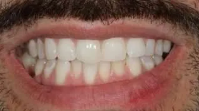 Close-up of a smiling mouth showing white teeth and a dark mustache above the lips