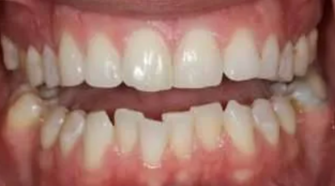 Close-up of open mouth showing upper and lower teeth and gums