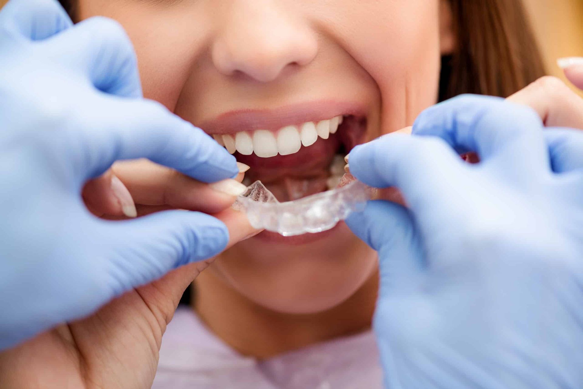 Hands fitting clear dental aligners over smiling mouth with braces.