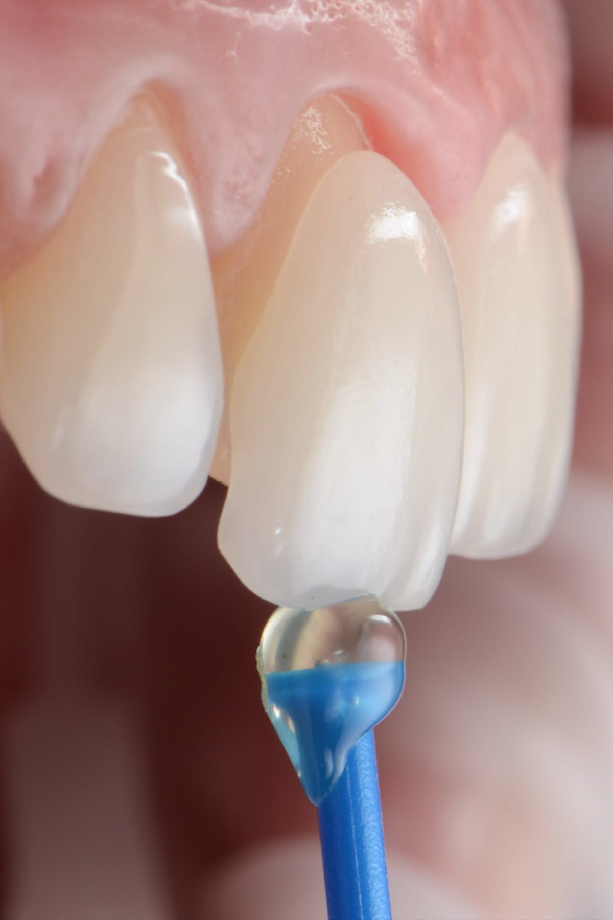Man smiling after comprehensive cosmetic dental care by Dr. Harkin