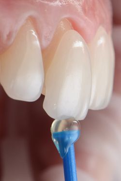 Man smiling after comprehensive cosmetic dental care by Dr. Harkin
