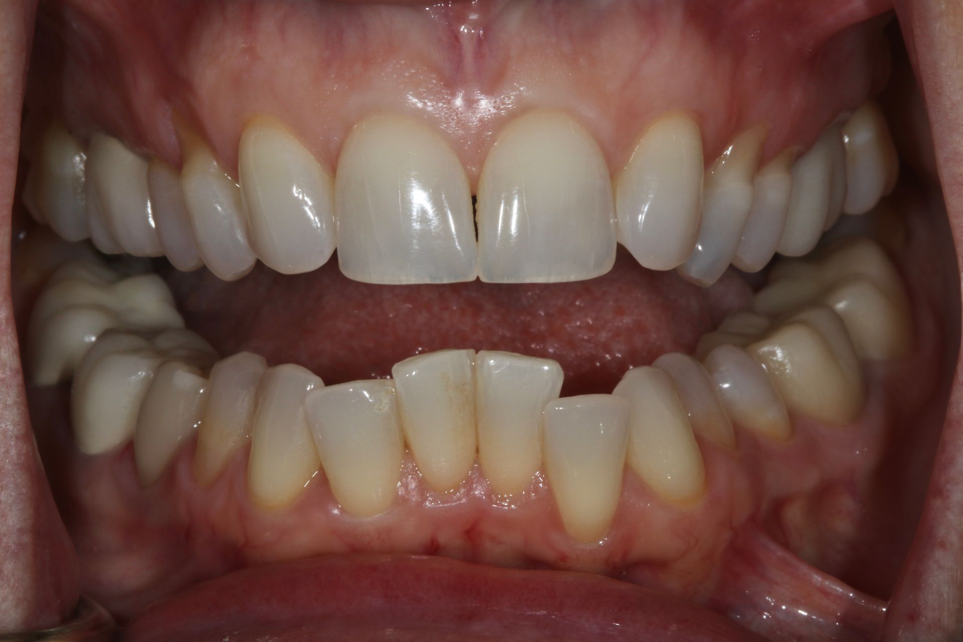 Open mouth showing upper and lower teeth, with mild crowding and gum tissue visible