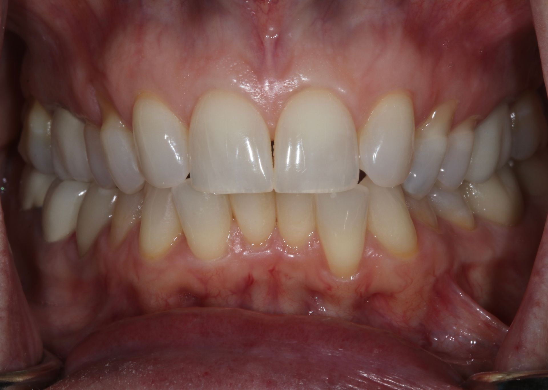 Close-up of a person’s mouth showing teeth and gums, with teeth slightly misaligned.