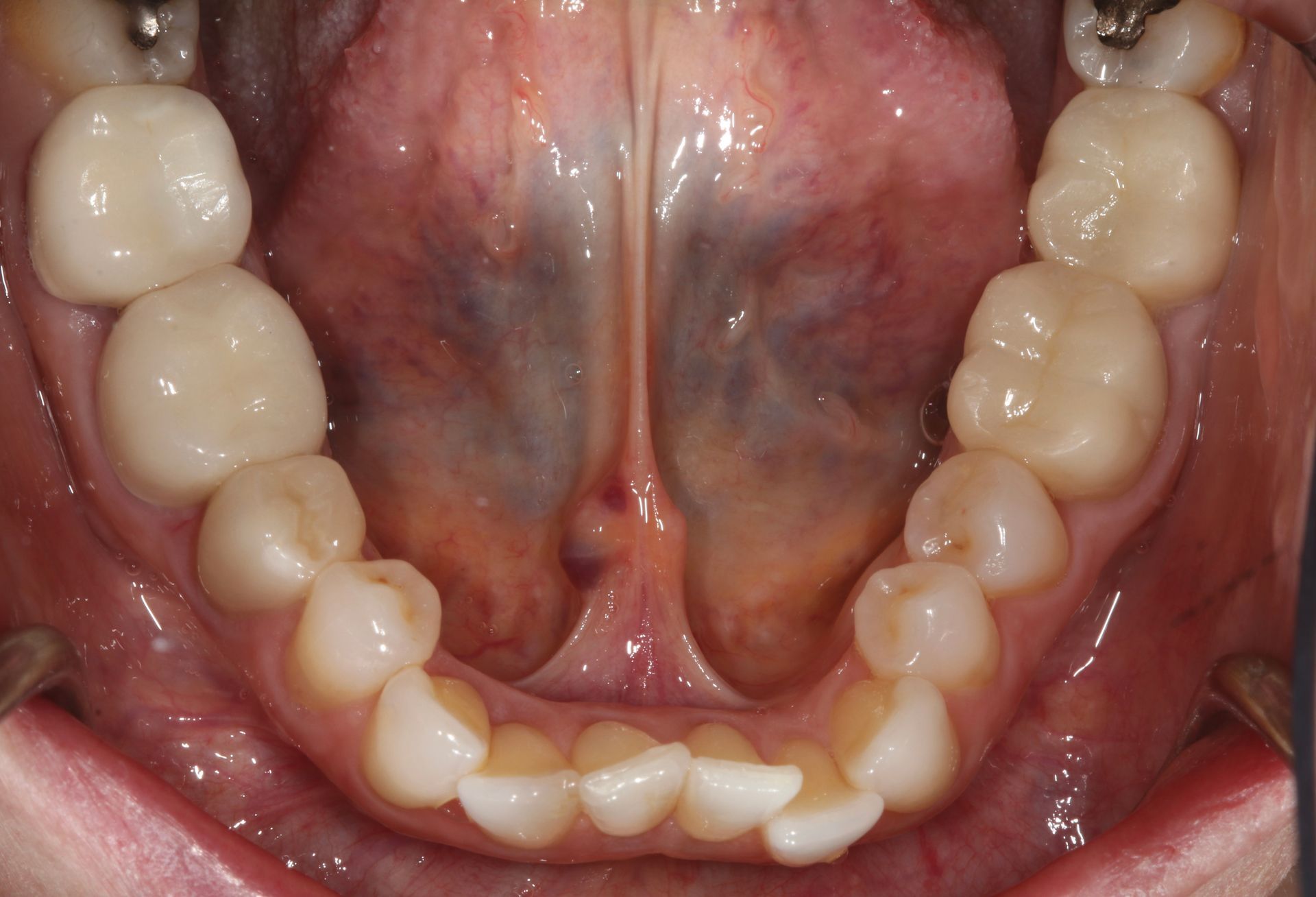 Inside view of a lower jaw with teeth and gums, showing a raised red area under the tongue