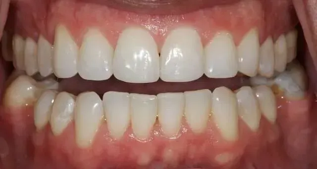Close-up of a mouth showing teeth with visible spacing between the upper and lower front teeth.