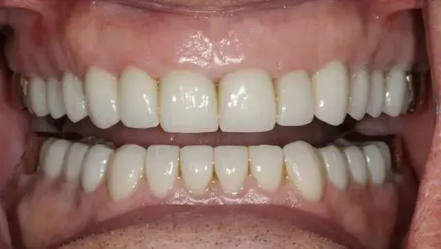 Close-up of a smiling mouth showing upper and lower teeth with braces-free, aligned teeth