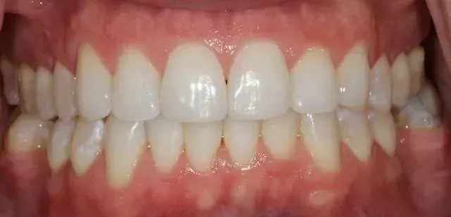 Close-up of teeth with visible front alignment and slight crowding