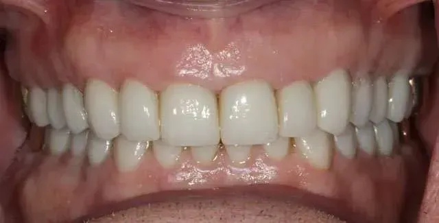 Close-up of a smiling mouth showing white teeth and pink gums
