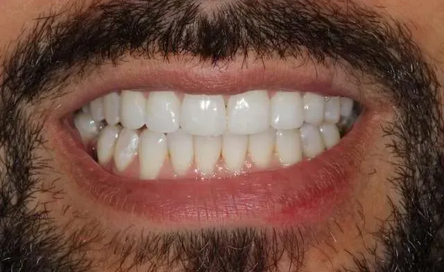 Close-up of a smiling mouth showing white teeth with facial hair around the lips and chin