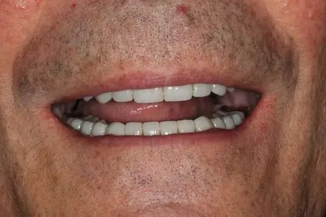Close-up of a smiling mouth showing white teeth with a dark gray mouthguard or dental appliance