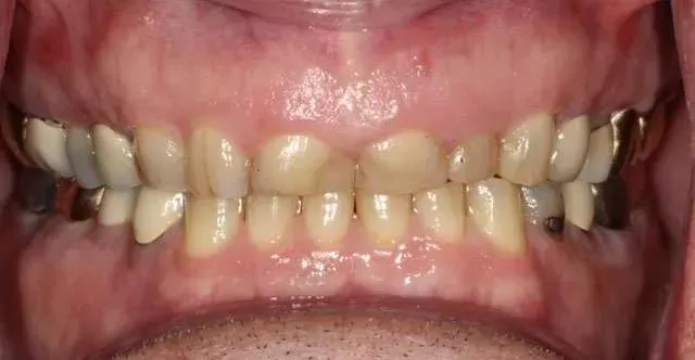 Close-up of a smiling mouth showing yellowed teeth and gums