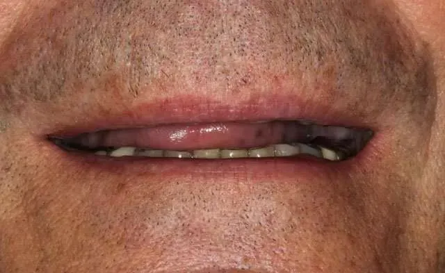 Close-up of a man's mouth with a stitched cut on the right side of the lip