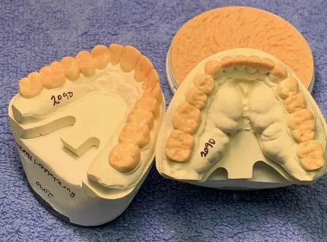 Two dental arch models with beige teeth and pink bases side by side on a blue surface