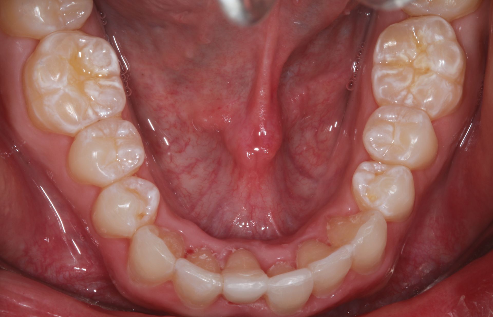 AFTER Invisalign treatment in New Holland, PA 2
