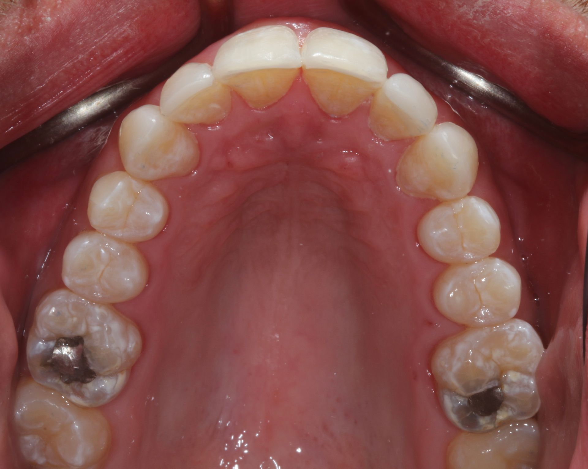 AFTER Invisalign treatment in New Holland, PA 3