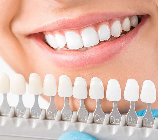 Dental shade guide matched to a smiling mouth, showing white teeth and color tabs