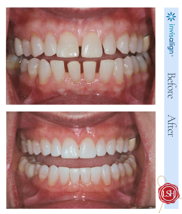 Before-and-after close-up of teeth alignment, with Invisalign logo between the two mouth photos.