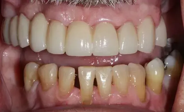 Close-up of upper and lower teeth with noticeable yellowing and gaps in the lower front teeth