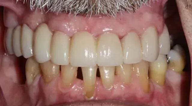 Close-up of teeth with upper dentures and yellowed lower front teeth in a mouth