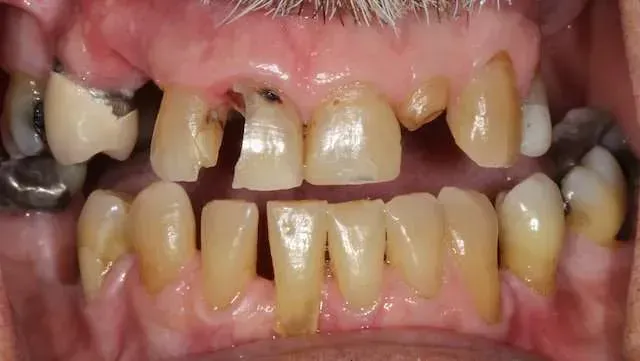 Close-up of severely decayed teeth with missing and discolored upper front teeth and crowded lower teeth