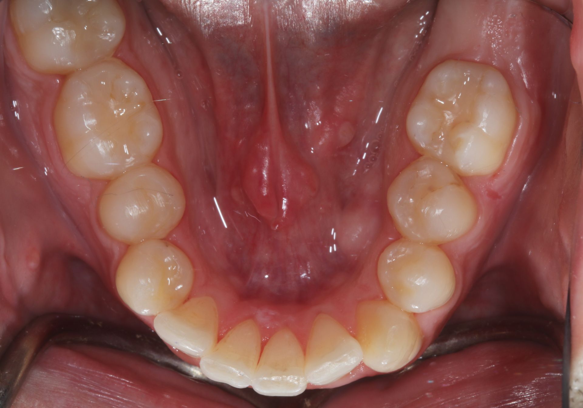 Close-up of the upper palate and teeth in a mouth, showing the inner dental arch.
