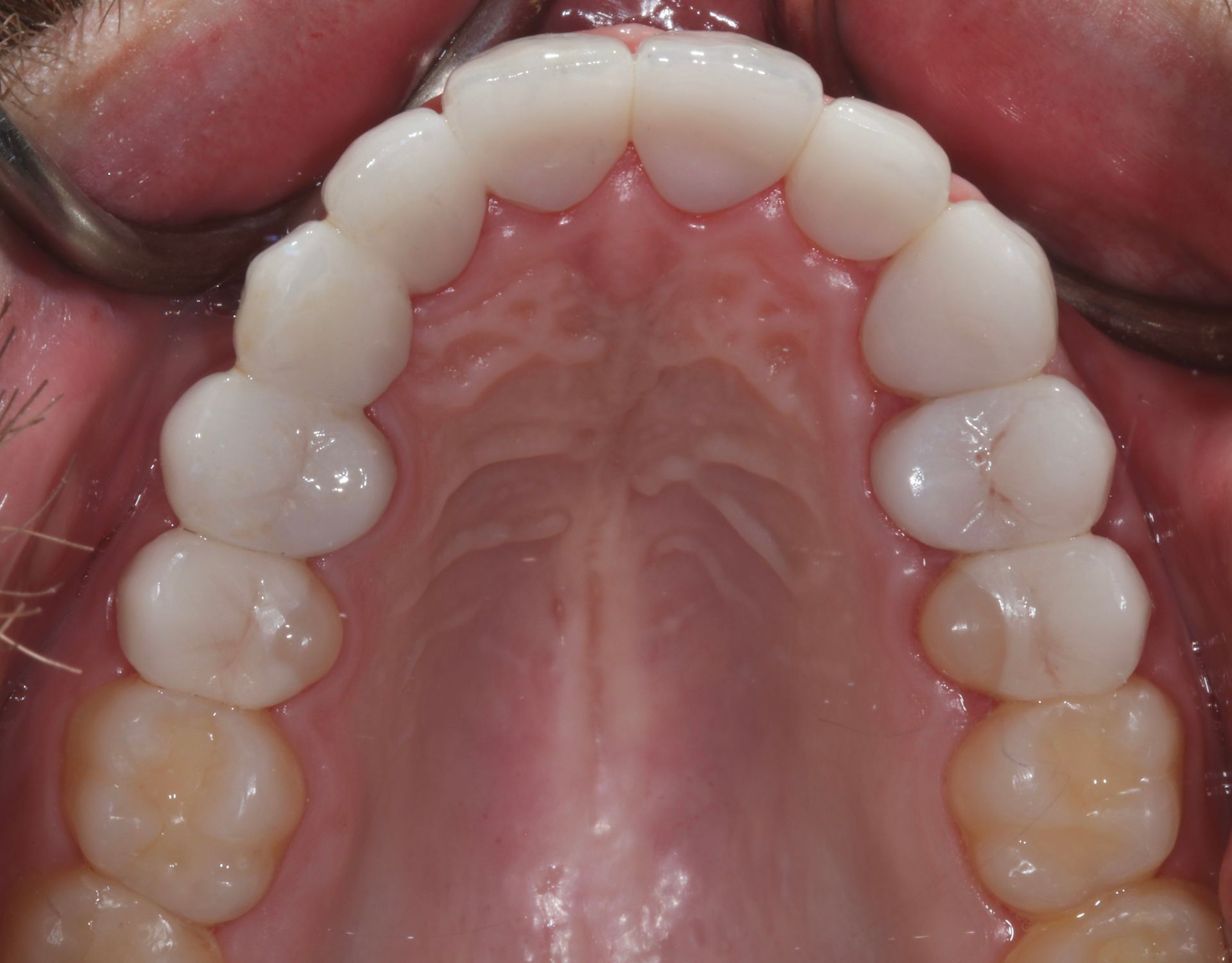 Close-up of the upper palate and teeth, showing a dental arch from below.