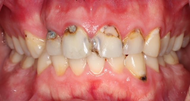 Close-up of stained, damaged front teeth with visible gum inflammation.