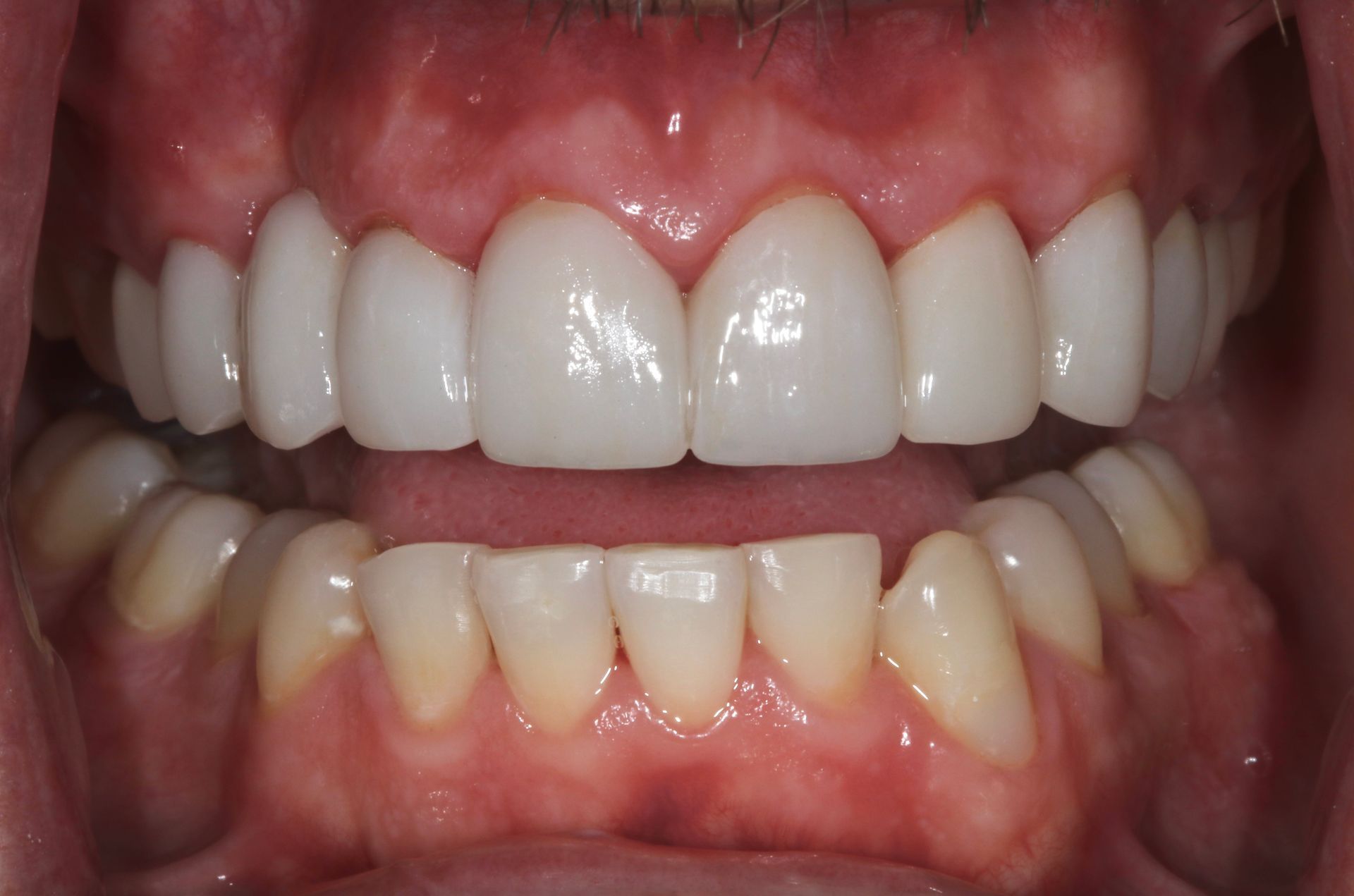 Close-up of a smiling mouth showing white upper teeth and slightly crooked lower teeth