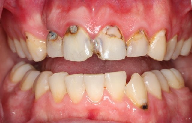 Close-up of severely decayed upper and lower front teeth with brown cavities and gum irritation