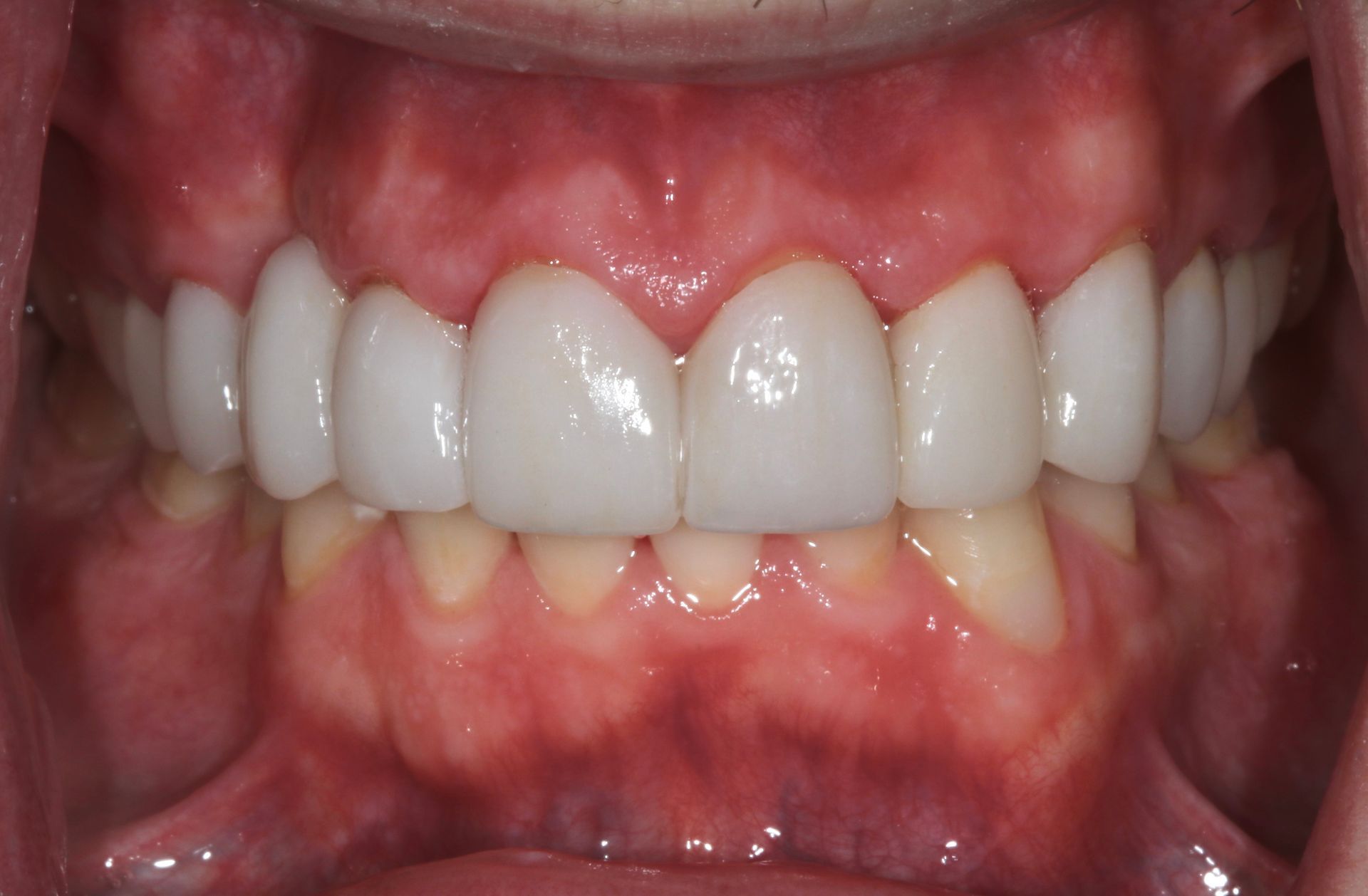 Close-up of teeth and gums, showing upper and lower front teeth in a mouth.