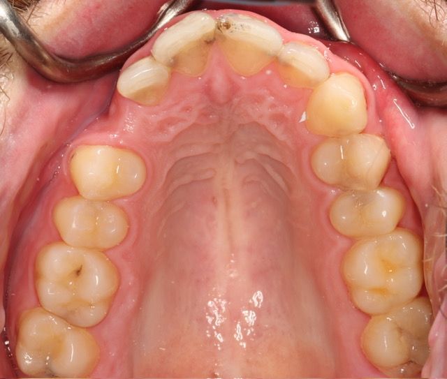 Close-up of the upper mouth, showing the palate and upper teeth from below.