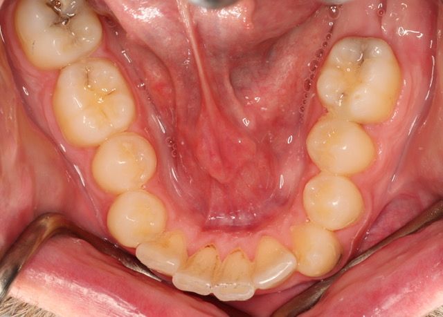 Close-up of a person’s lower teeth and gums, showing the inside of the mouth.