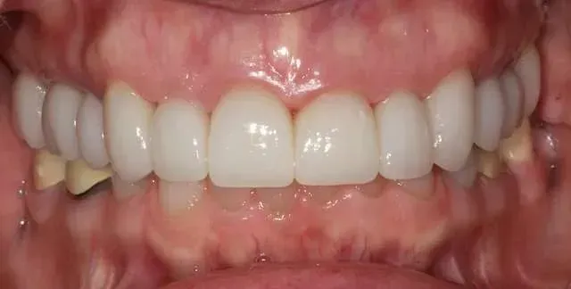 Close-up of a person's mouth showing white upper and lower teeth, with a small yellow chip on a back tooth.