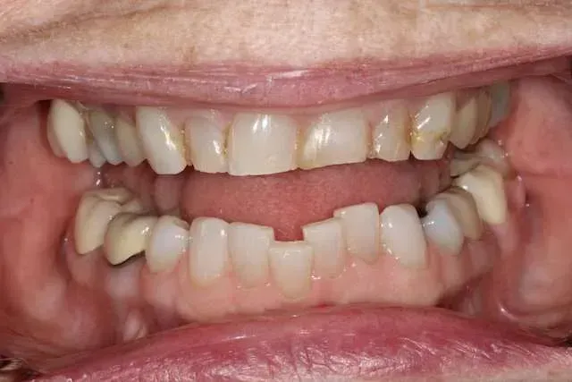 Close-up of an open mouth showing crowded, misaligned teeth and visible gums