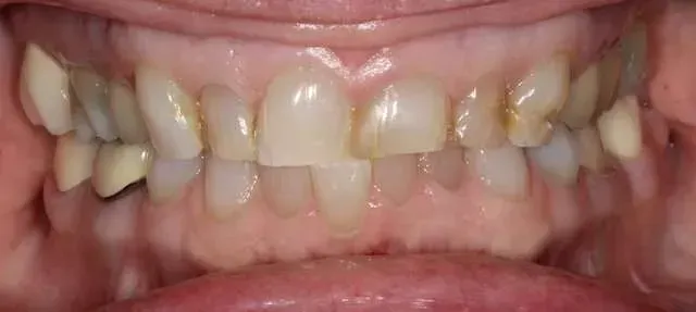 Close-up of teeth and gums with visible yellowing and slight crowding