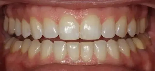 Close-up of a person's mouth showing straight, white teeth in a relaxed bite