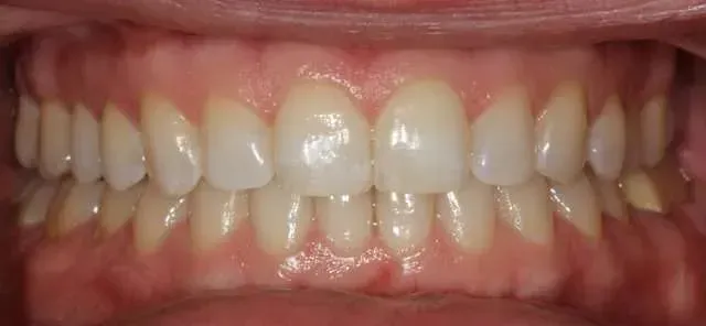 Close-up of a smiling mouth with visible teeth and pink gums