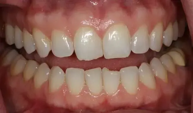 Close-up of a smiling mouth showing upper and lower teeth and pink gums