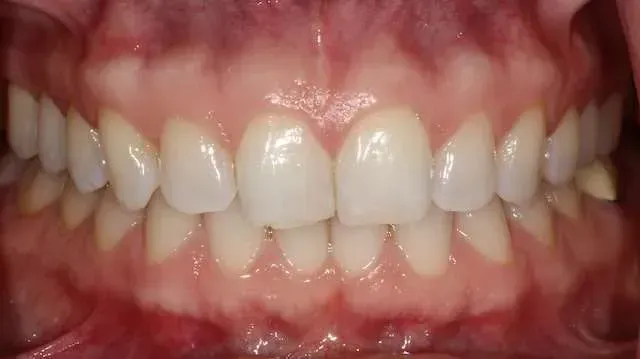 Close-up of a person’s teeth and gums with lips parted, showing natural front teeth alignment