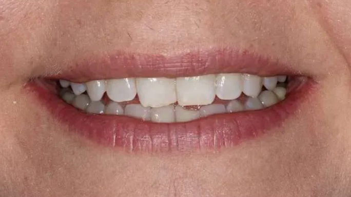 Close-up of a smiling mouth showing white teeth and pink lips