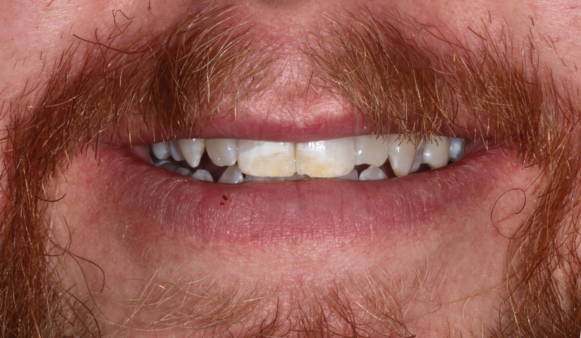 Invisalign treatment New Holland, PA dentist - BEFORE