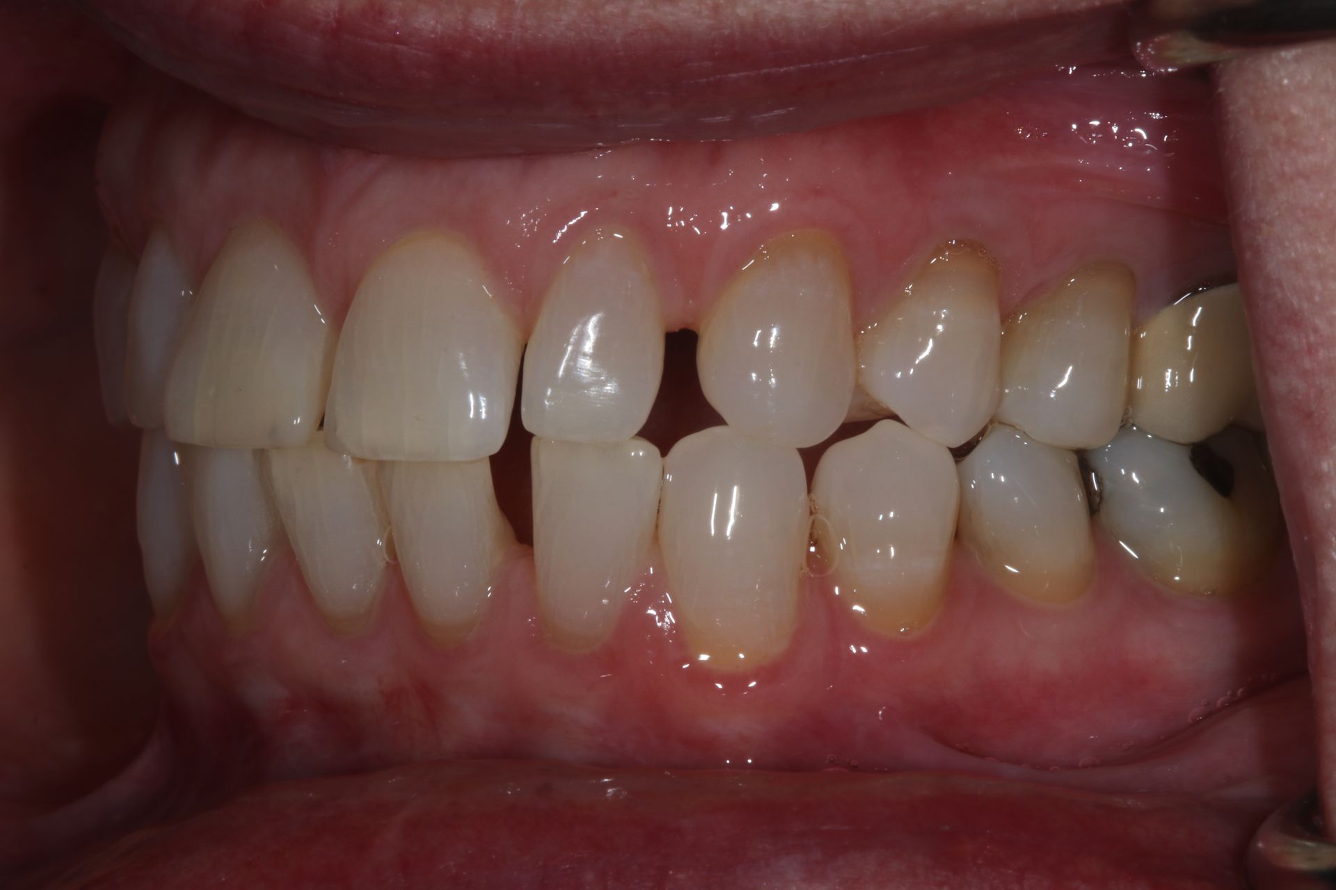 BEFORE Invisalign treatment new holland pa patient 3
