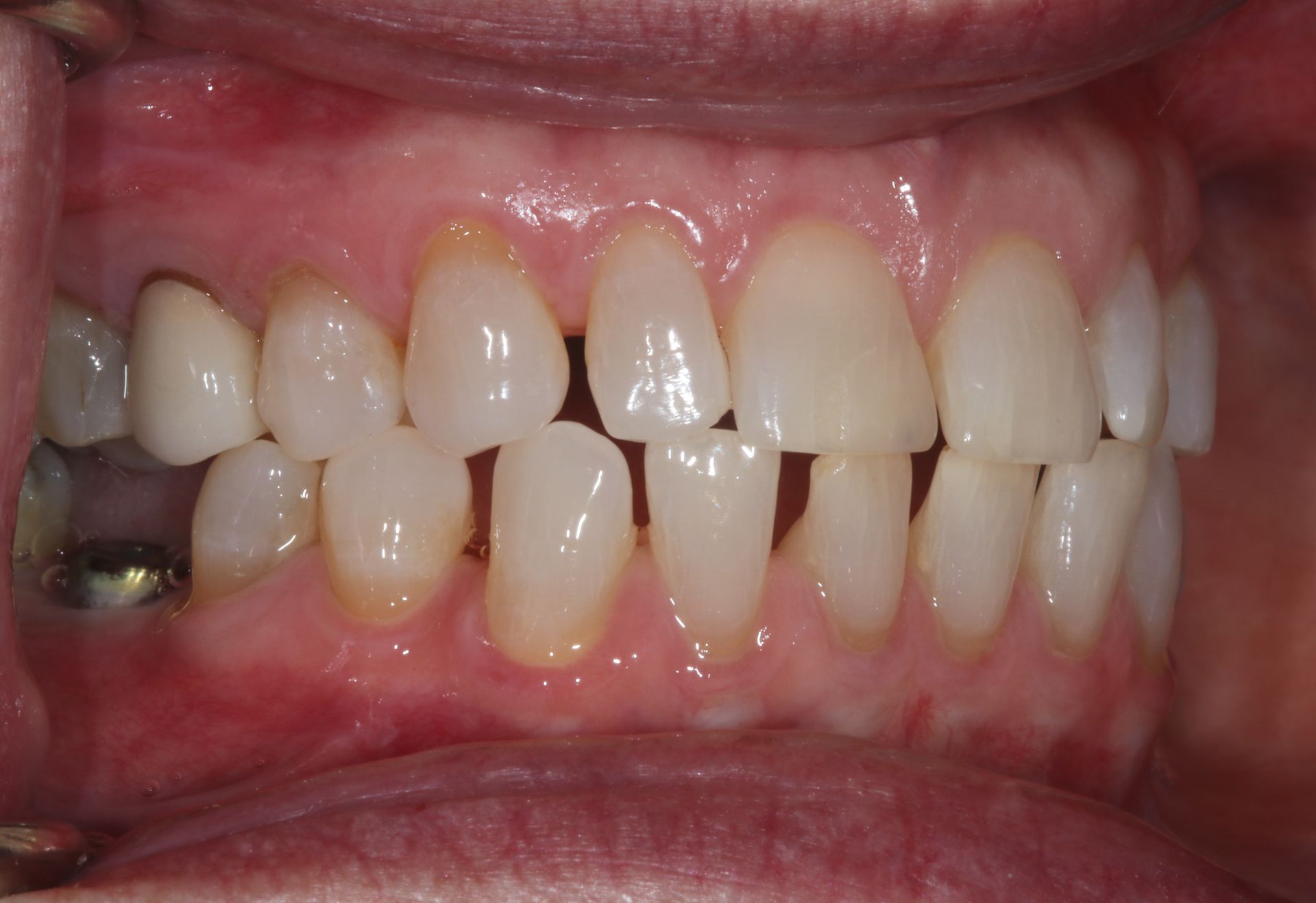BEFORE Invisalign treatment new holland pa patient 4