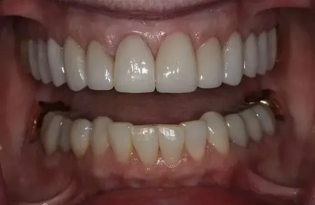 Close-up of open mouth showing upper and lower teeth, with lower teeth slightly crowded and discolored.