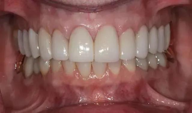 Close-up of a mouth showing teeth and gums during a dental smile exam