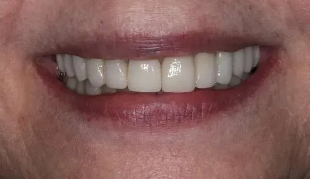 Close-up of a smiling mouth showing white teeth and pink lips