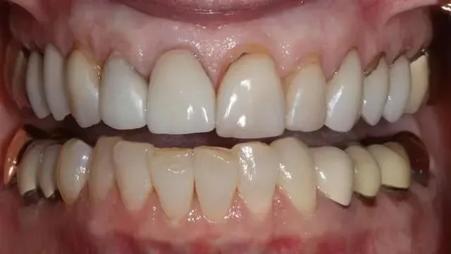 Close-up of a smiling mouth showing upper and lower teeth with visible alignment and gumline.