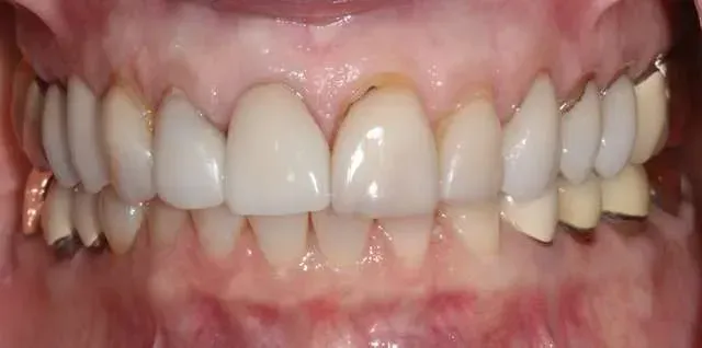 Close-up of a mouth showing teeth with braces and pink gums